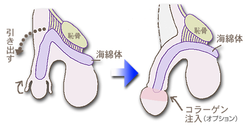 尿道下裂