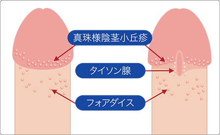 真珠様陰茎丘疹症 | 銀座ヒカリクリニック