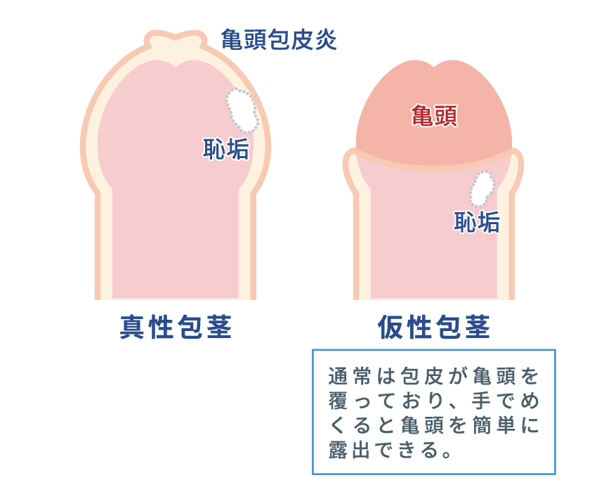 亀頭増大術とは？施術方法や得られる効果について解説 | コラム一覧｜  東京の婦人科形成・小陰唇縮小・婦人科形成（女性器形成）・包茎手術・膣ヒアルロン酸クリニック