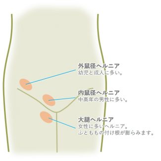 鼠径（そけい）ヘルニア外来 | 医療法人社団 鶴友会