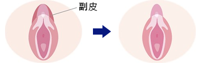 被さっているクリトリスの皮(クリトリス包茎)の治療,サンライズの美容外科