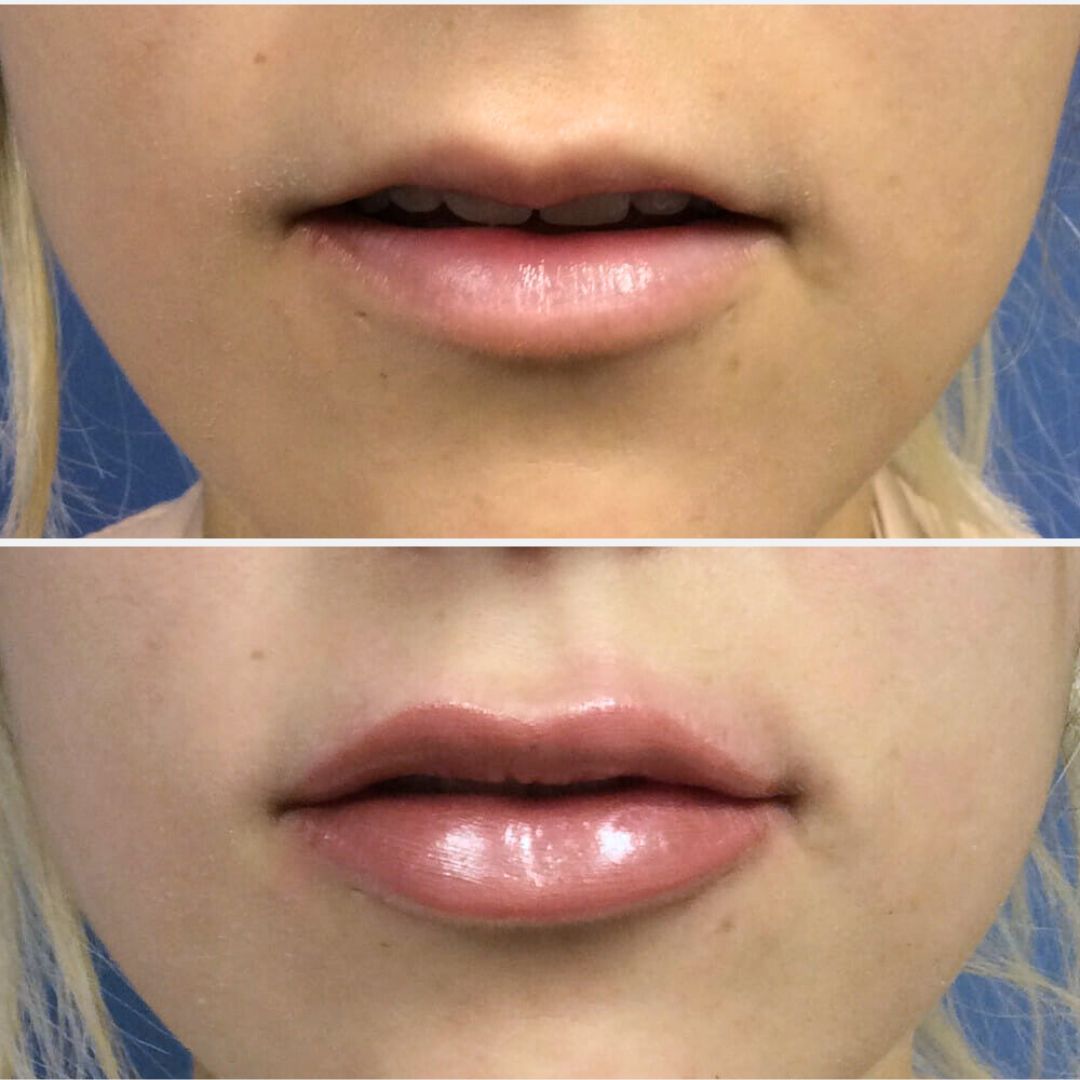 Revanesse Versa+ and Lips+ -