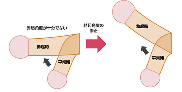 陰茎湾曲症の原因と手術について | 男性不妊治療は銀座リプロ外科