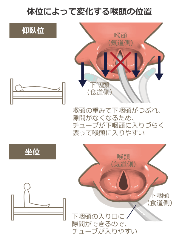 尿道カテーテルQ&A「尿道カテーテル挿入・留置時の尿道損傷、どう防ぐ？」│看護師ライフをもっとステキに ナースプラス