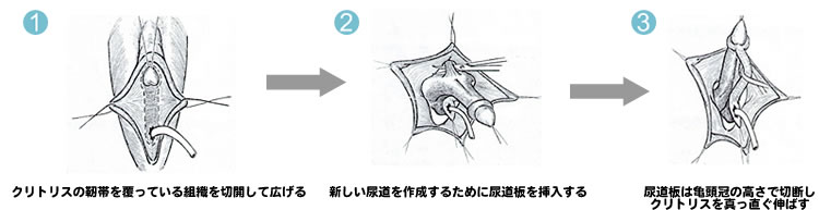 性転師』知られざる性転換ビジネスの裏方<br />「アテンド業」の実態に迫る - HONZ