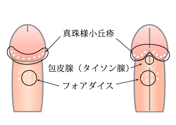 ちんこに真珠を入れたらヤバいって本当？改造ちんこのメリットやデメリット、やり方など徹底解説！ | Men's Chinchi