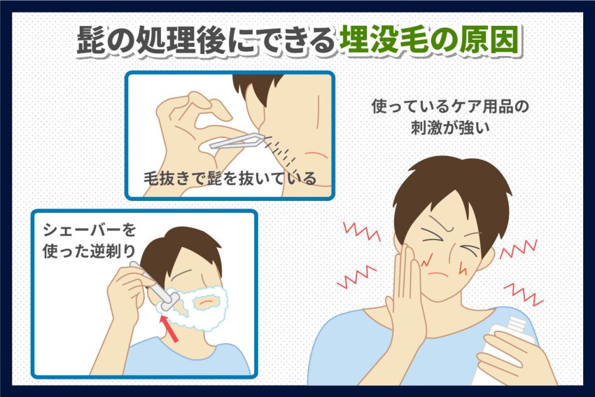 髭を抜くと生えなくなる?毛抜きのデメリットやおすすめのメンズ脱毛を紹介