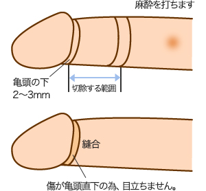 最新の小児包茎の治療方針-これでもうママも悩まない- －泌尿器科－｜KOMPAS