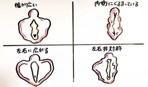 小陰唇の形や大きさの平均は？正しい位置とともに肥大化のセルフチェックを解説｜スワンクリニック銀座