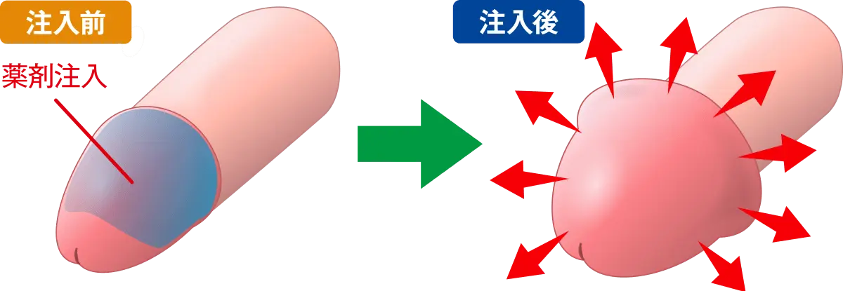 亀頭下直線切開包茎手術（クランプ法） ： 男性器（包茎、長茎など）：美容外科