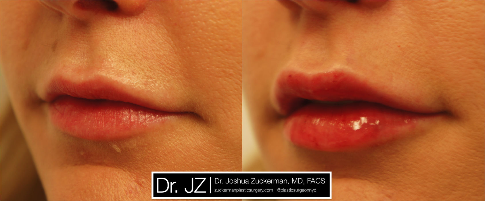 STYLAGE Lips Plus Lidocaine