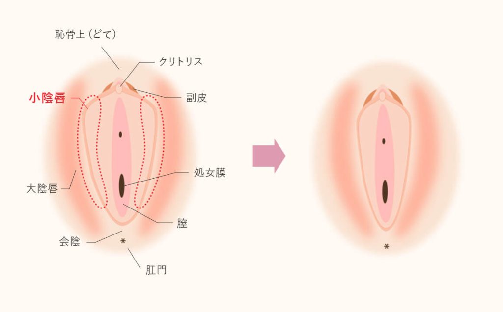 小陰唇縮小 | ゆかりレディースクリニック 神戸市三宮にある婦人科