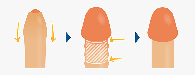 泌尿器専門医が解説】異物を入れずにカリ高ペニスを作る唯一の方法