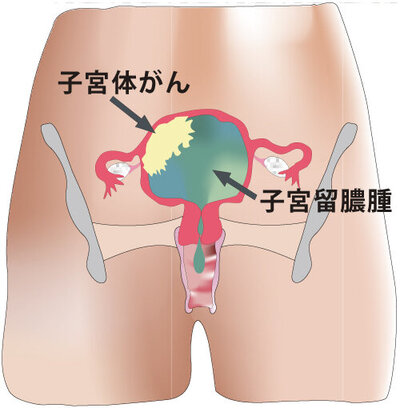 ヘルニア – 京都大学消化管外科