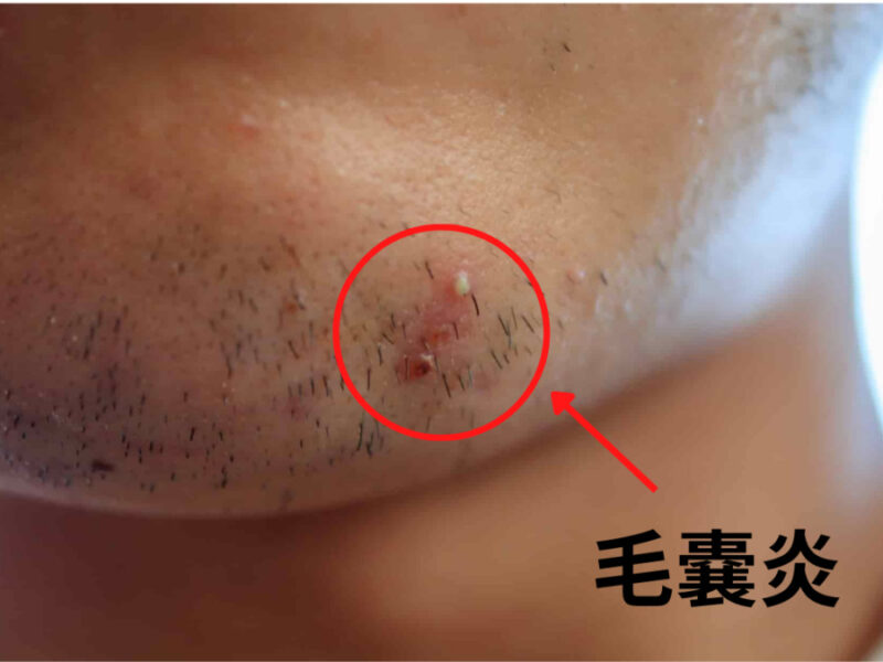 閲覧注意】髭Wax脱毛で青髭無くせるんじゃない？ - YouTube