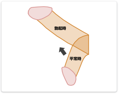下向きになった男性器（ペニス）を上反りにする治療症例 | 症例写真・体験談｜包茎・ED治療など男性形成なら銀座みゆき通り美容外科 東京銀座・大阪梅田