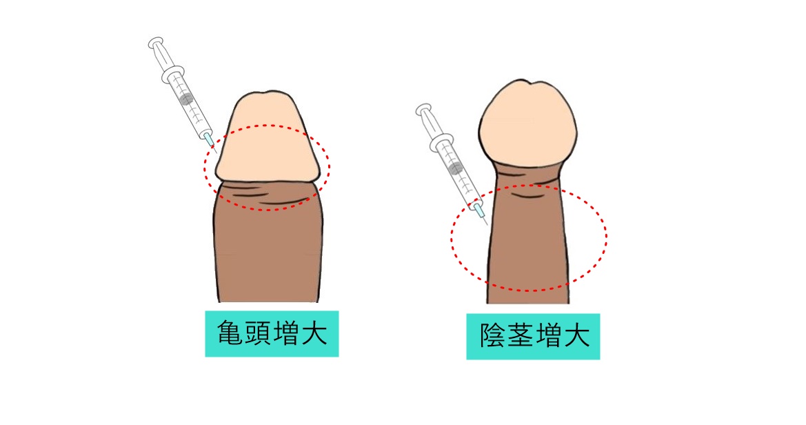 クリトリス包茎で叶える快適なインティメイトケア | ガーデンクリニック