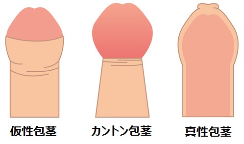 デブには包茎が多い」は事実だった！？脂肪と包茎の関係やその他の弊害を解説 | メンズライフクリニック【公式】