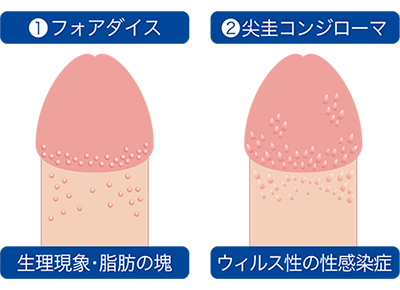 亀頭周囲のぶつぶつ除去 ： 男性器（包茎、長茎など）：美容外科