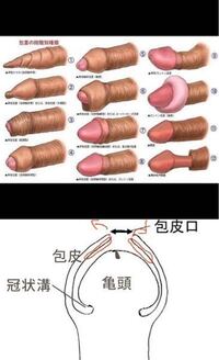 包茎の種類と手術について ｜ 烏丸御池院 いちおか泌尿器科クリニック