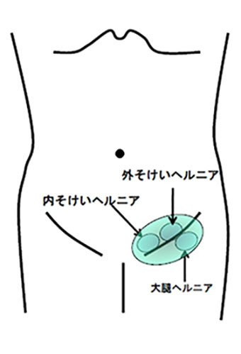 2024年】大阪府の鼠径ヘルニア治療 おすすめしたい5医院 |