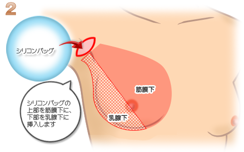 経鼻経管栄養チューブ挿入　観察、挿入、固定