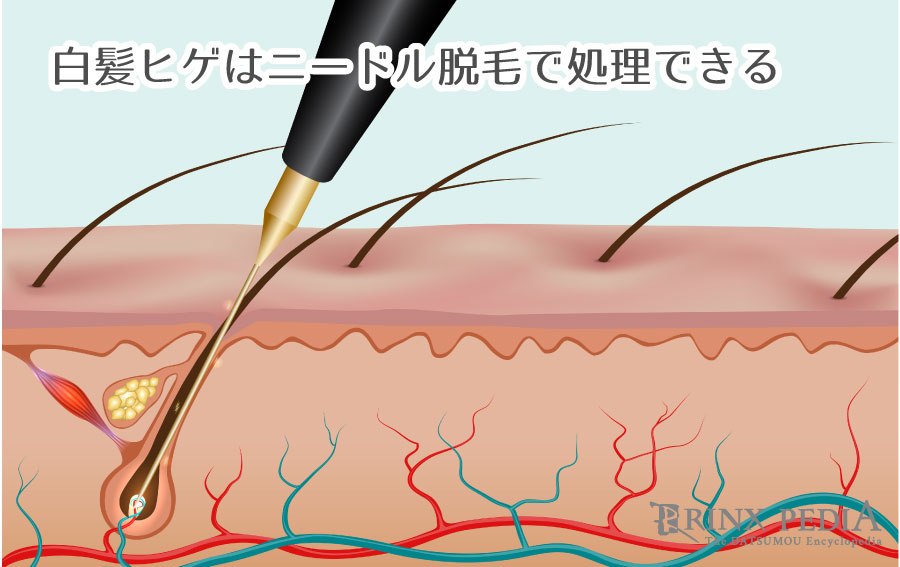 壮絶ガチ検証】脱毛ワックスで髭は脱毛できるのか？