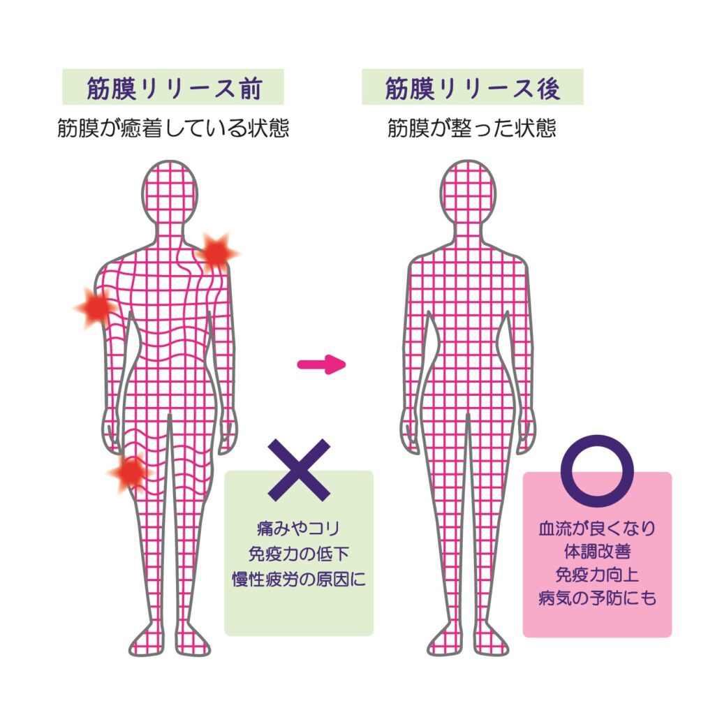 筋膜リリースの基礎と実践（腰痛に対する筋膜セラピー） | 筋膜、自律神経、ウィメンズ・ヘルスケアのセミナー｜トリガースクール