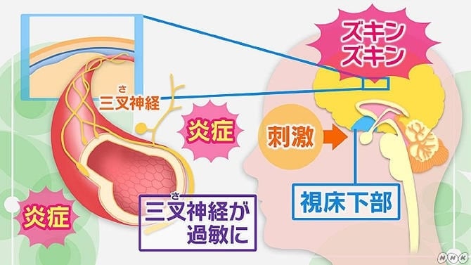 性交時頭痛（セックスやオナニーの時に頭が痛くなる）