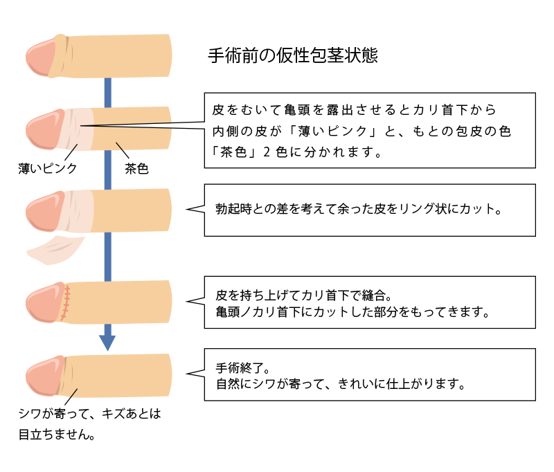 包茎手術について｜京都・滋賀の大西皮フ科形成外科医院【大津石山,四条烏丸】