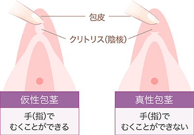 男性向け】クリトリスの皮の剥き方│包茎の見分け方・注意点もご紹介！｜駅ちか！風俗雑記帳