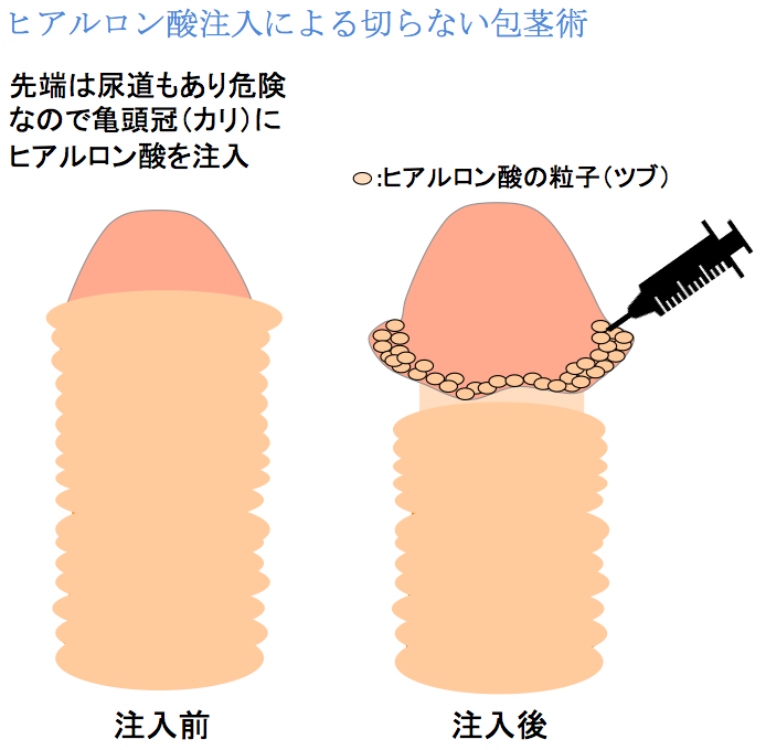 剥くか剥かないべきかどちらなの？ | 名古屋 風俗デリヘル女性高収入求人｜宮殿グループ