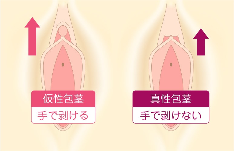 クリトリス包茎 | 婦人科形成なら城本クリニック