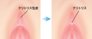 包茎 | 診療部門のご案内