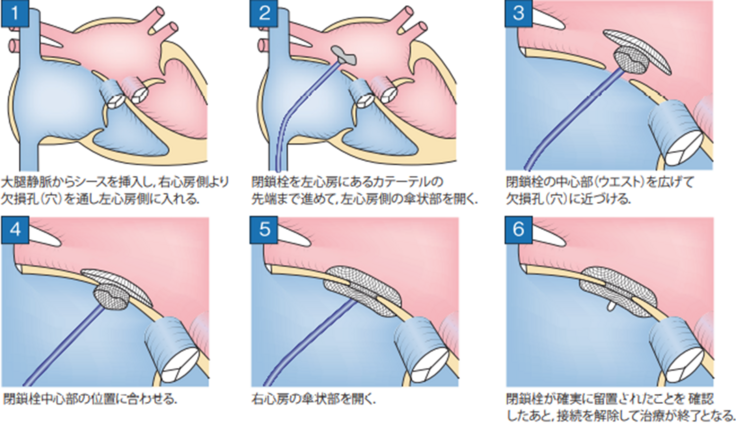 ねじ子web » 完璧手技第7回 胃管挿入＆胃洗浄