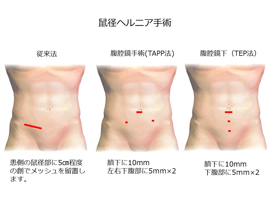 鼠径ヘルニア(脱腸)は福岡のおだクリニック日帰り手術外科へ