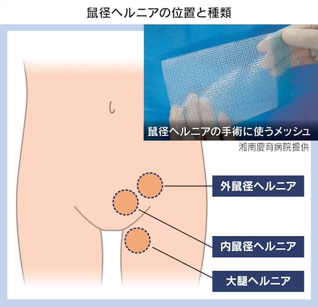 楽天市場】 脱腸サポーター 脱腸ベルト