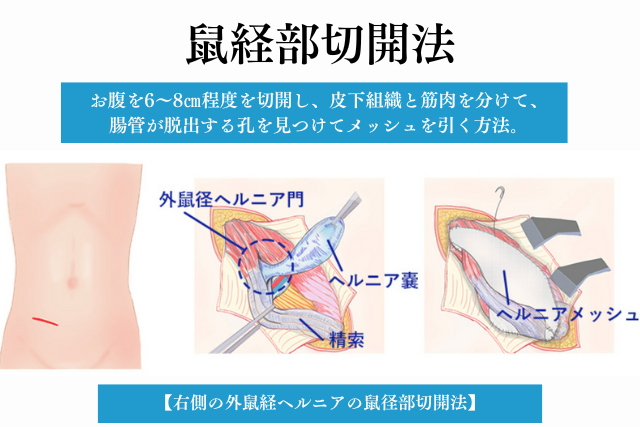 鼠径ヘルニア（脱腸）は日帰り手術｜大阪市の多根総合病院