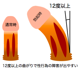 曲がった男性器を真っ直ぐにする方法【性のお悩み相談vol.8】