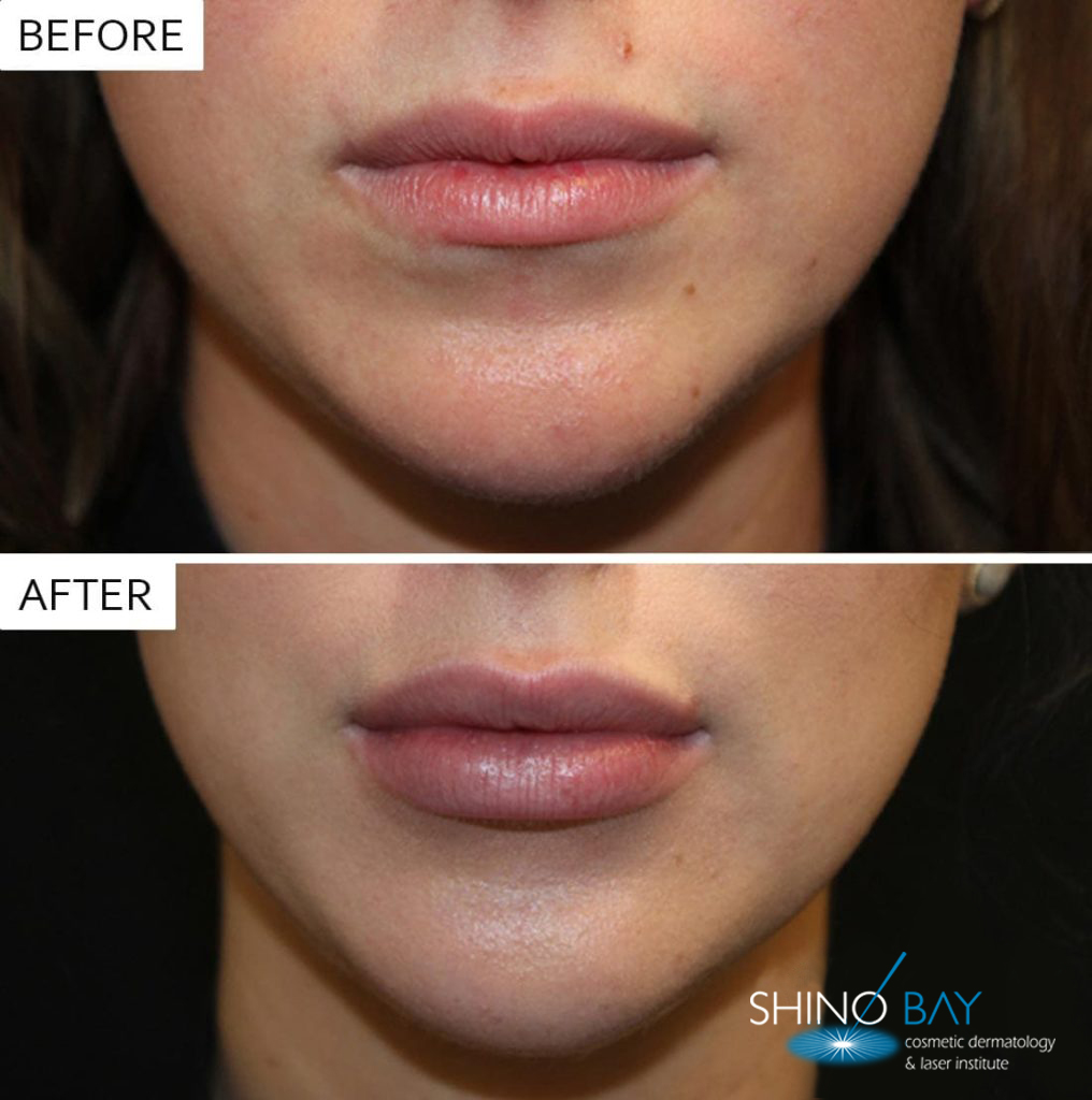 Lip Injections Before After