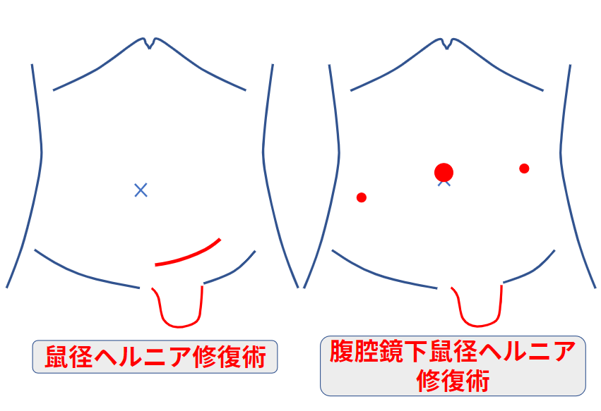 男性に多い鼠径ヘルニア・脱腸の症状を解説！