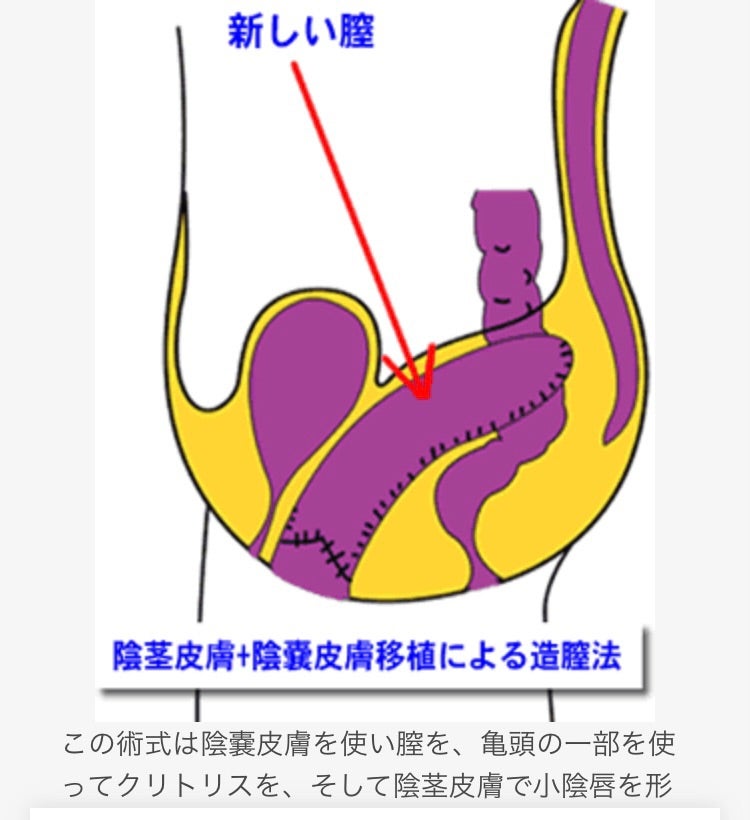 クリトリス包茎手術｜見た目・感度を改善！女性器整形「クリトリス包茎手術」の効果・経過・ダウンタイムとは｜美容整形・美容外科のTAクリニックグループ