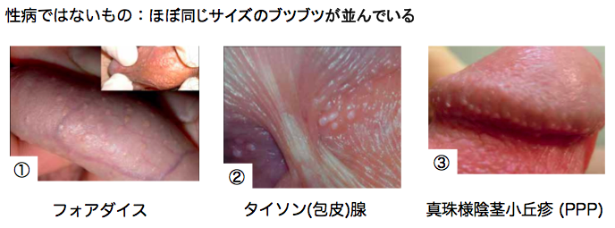 亀頭にピアスを入れた。 | チンコに真珠が入ってます！