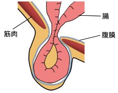 鼠径部しこりで疑うべき疾患 | 鼠径ヘルニア日帰り外科広島アルプスクリニック