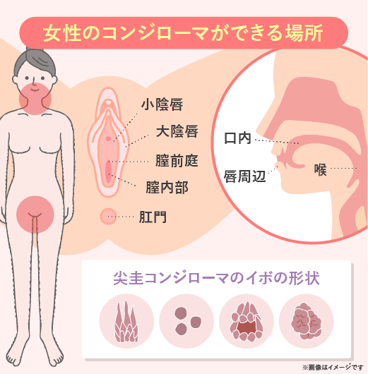 尖圭コンジローマの検査と治療【男女別症状や感染経路、感染率は？】|天神マイケアクリニック