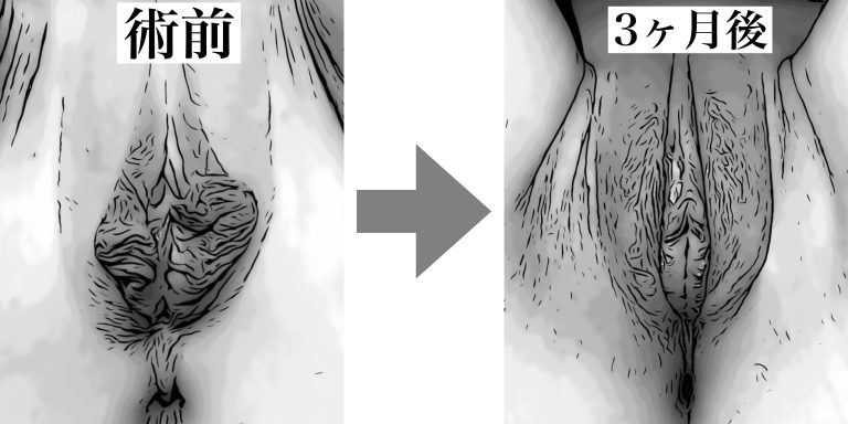 ビラビラがはみ出るのはよくある？小陰唇の平均サイズや治療法を紹介｜アリエル美容クリニック郡山院