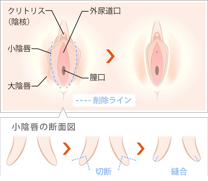 クリトリス包茎手術｜見た目・感度を改善！女性器整形「クリトリス包茎手術」の効果・経過・ダウンタイムとは｜美容整形・美容外科のTAクリニックグループ