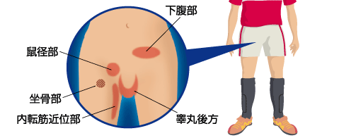 そけい部ヘルニアの日帰り手術。身体に負担の少ない、ヒトツキズ腹腔鏡 | 滋賀大津そけいヘルニア外科クリニック