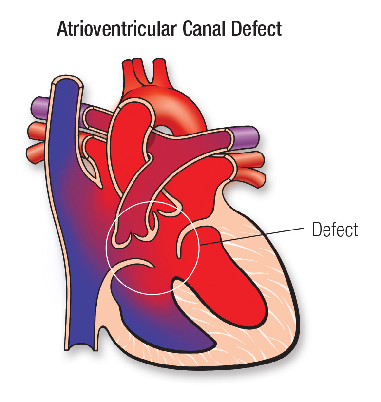 Complete Atrioventricular Canal