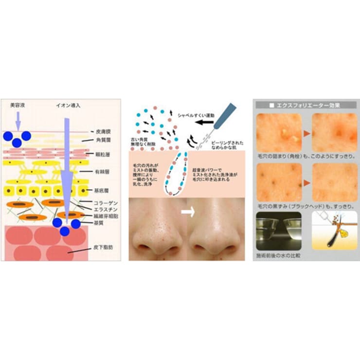 毛穴吸引機 黒ずみ 除去 吸引器